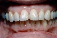 Lädierte Frontzähne