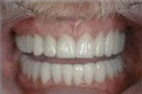 Veneers verdecken Zahnlücke