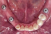3 Implantate in den Unterkiefer eingesetzt 3 Implantate als Basis eingesetzt