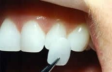 Veneering - Zahnarzt Braunschweig Veneer mit Pinzette einsetzen