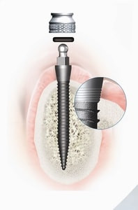 Mini-Implantat Braunschweig Detailansicht eines Mini-Implantats