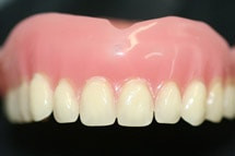 Totalprothese Totalprothese