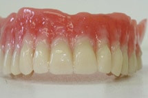 Herkömmliche Zahnaufstellung Herkömmliche Zahnaufstellung