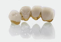 Festsitzender Zahnersatz Festsitzender Zahnersatz