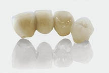 Vollkeramische Kronen und Brücken Vollkeramische Kronen und Brücken
